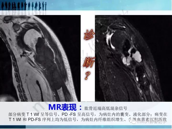 【PPT】纤维囊性骨炎的影像诊断