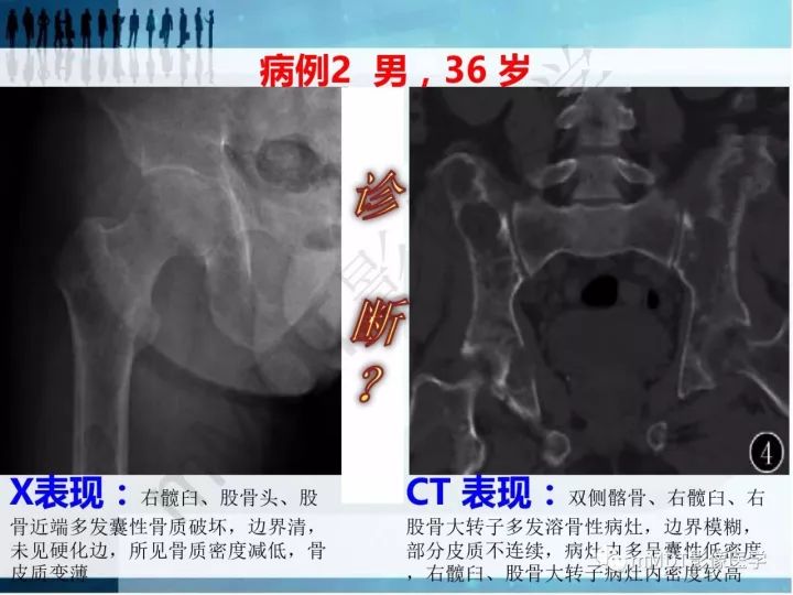 【PPT】纤维囊性骨炎的影像诊断