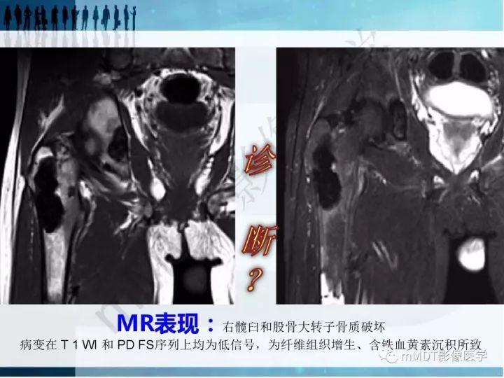 【PPT】纤维囊性骨炎的影像诊断