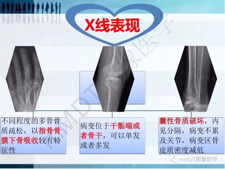 【PPT】纤维囊性骨炎的影像诊断