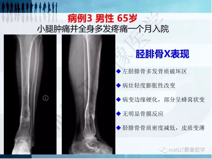 【PPT】纤维囊性骨炎的影像诊断