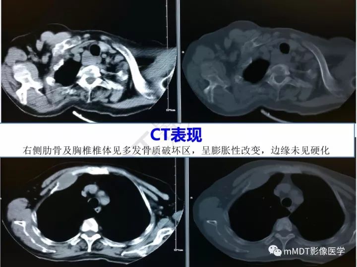 【PPT】纤维囊性骨炎的影像诊断