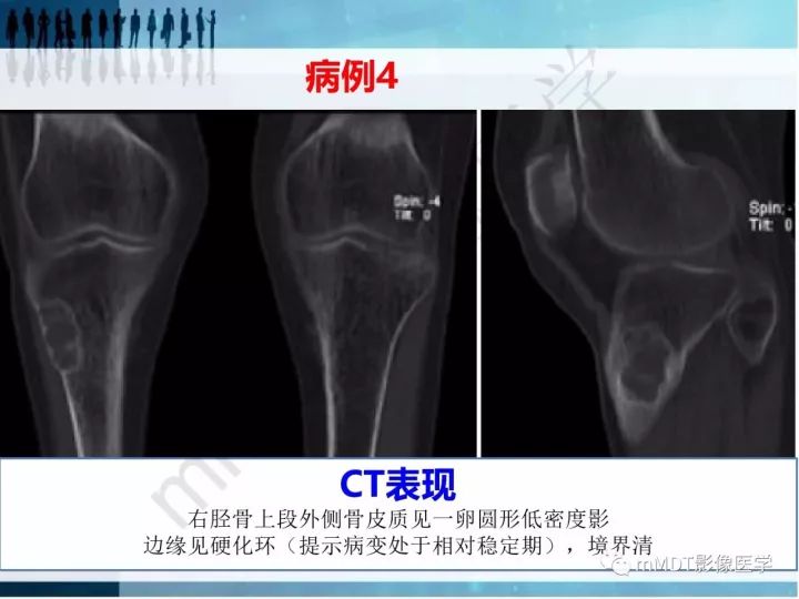 【PPT】纤维囊性骨炎的影像诊断