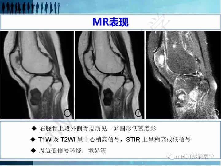 【PPT】纤维囊性骨炎的影像诊断