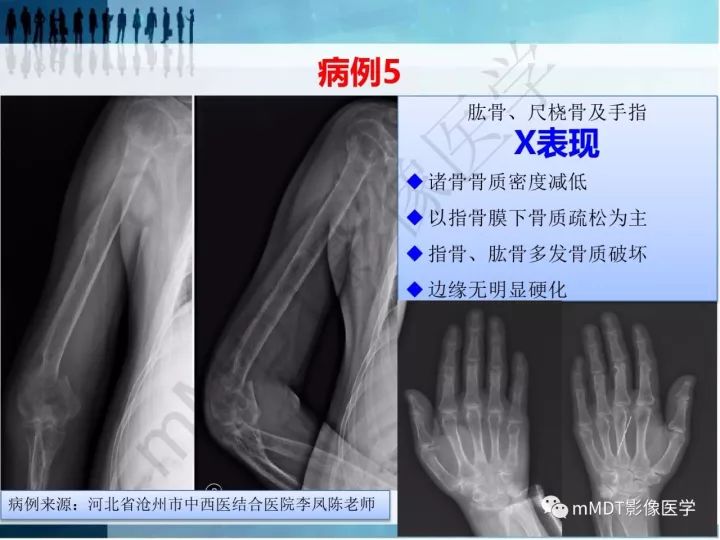 【PPT】纤维囊性骨炎的影像诊断