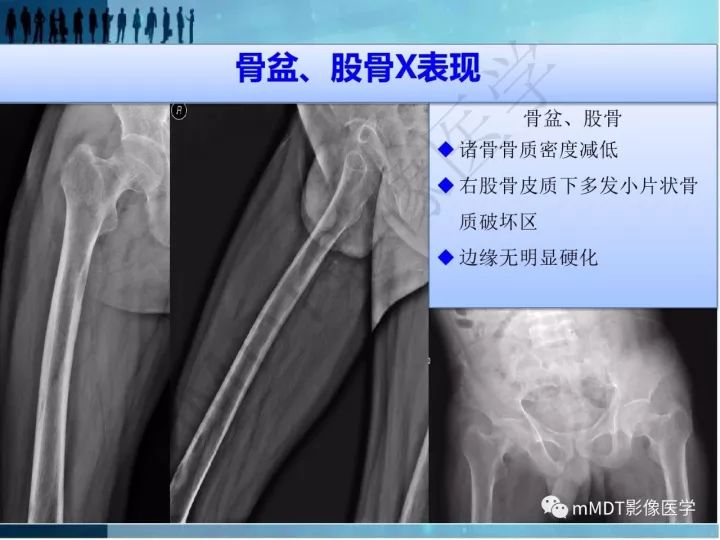 【PPT】纤维囊性骨炎的影像诊断