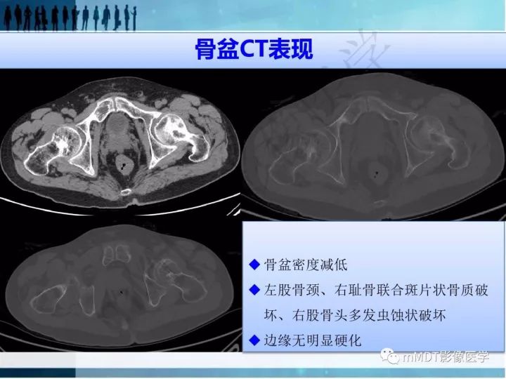 【PPT】纤维囊性骨炎的影像诊断