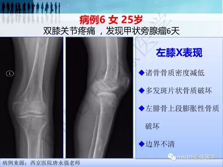【PPT】纤维囊性骨炎的影像诊断