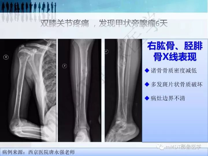 【PPT】纤维囊性骨炎的影像诊断