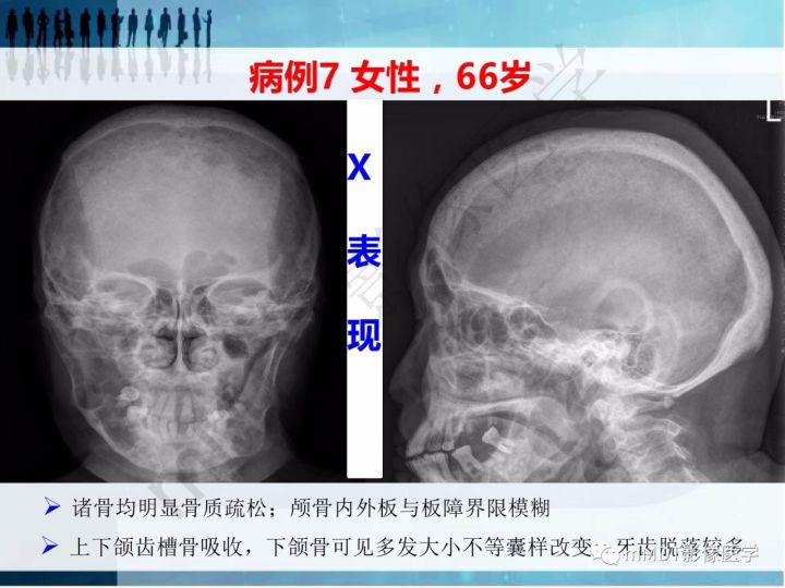 【PPT】纤维囊性骨炎的影像诊断