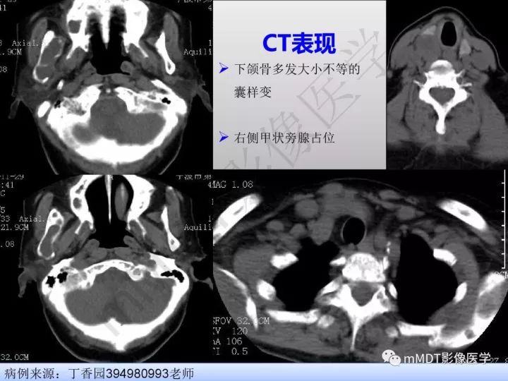 【PPT】纤维囊性骨炎的影像诊断