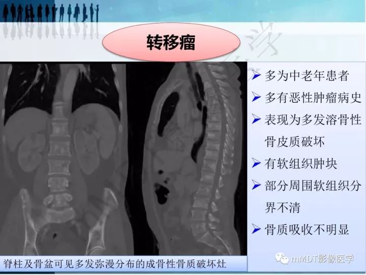 【PPT】纤维囊性骨炎的影像诊断