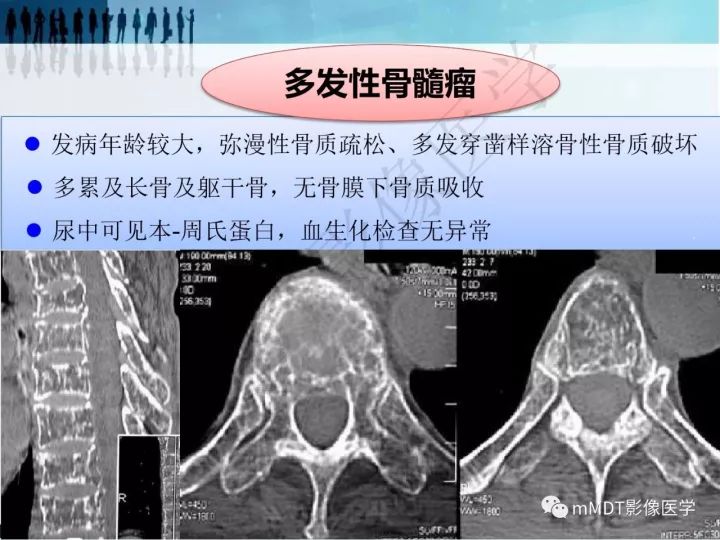 【PPT】纤维囊性骨炎的影像诊断