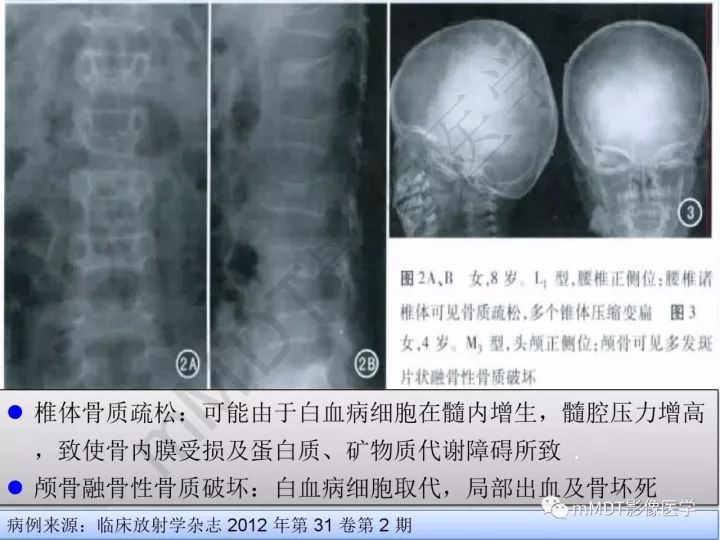 【PPT】纤维囊性骨炎的影像诊断