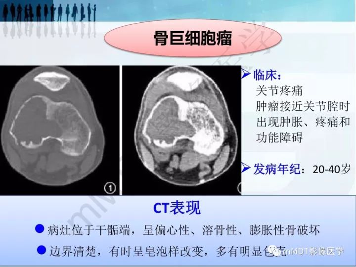 【PPT】纤维囊性骨炎的影像诊断