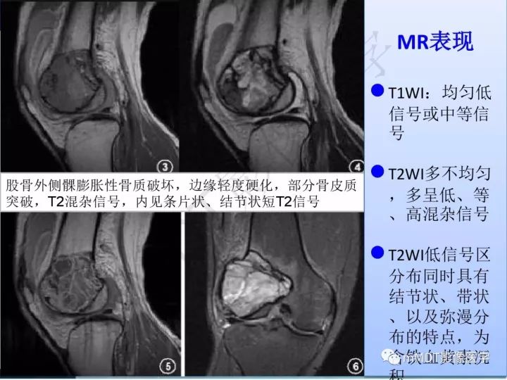 【PPT】纤维囊性骨炎的影像诊断