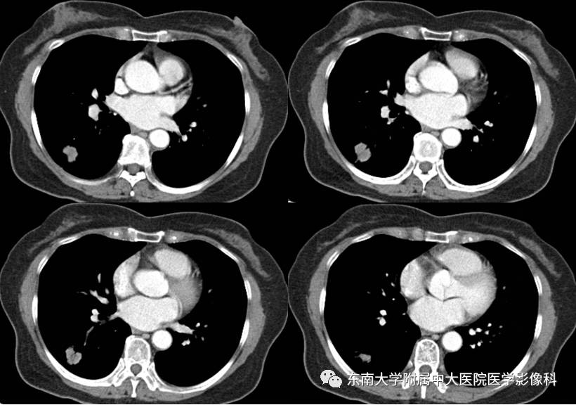 【病例】肺炎性假瘤1例CT影像表现