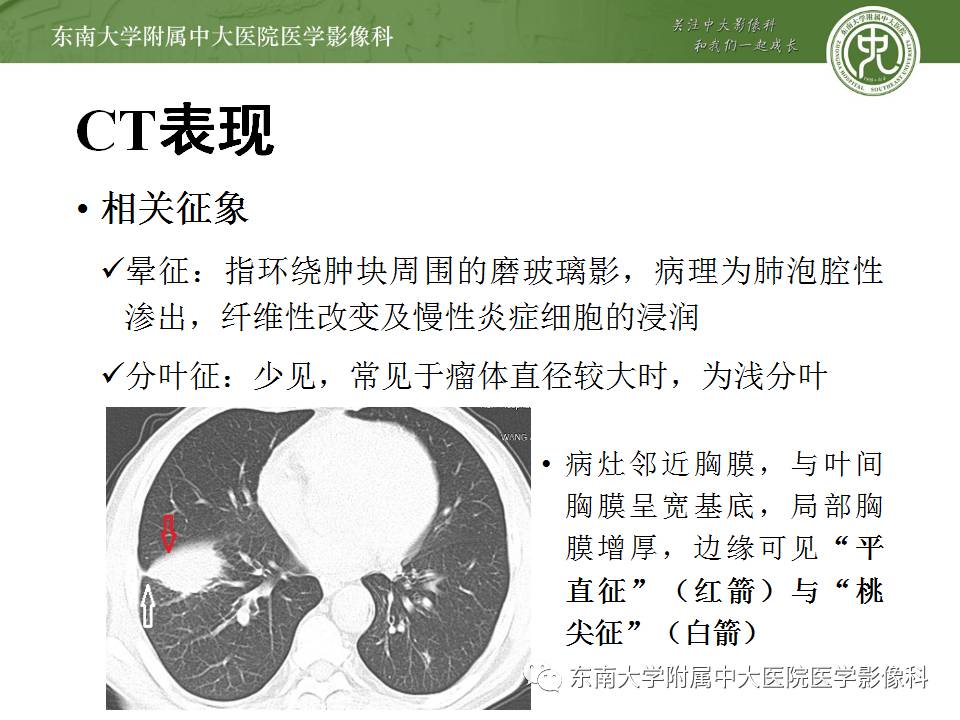 【病例】肺炎性假瘤1例CT影像表现