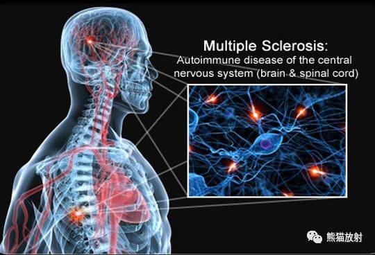 多发性硬化(MS)、急性播散性脑脊髓炎(ADEM) 多发性硬化(MS)、急性播散性脑脊髓炎(ADEM)