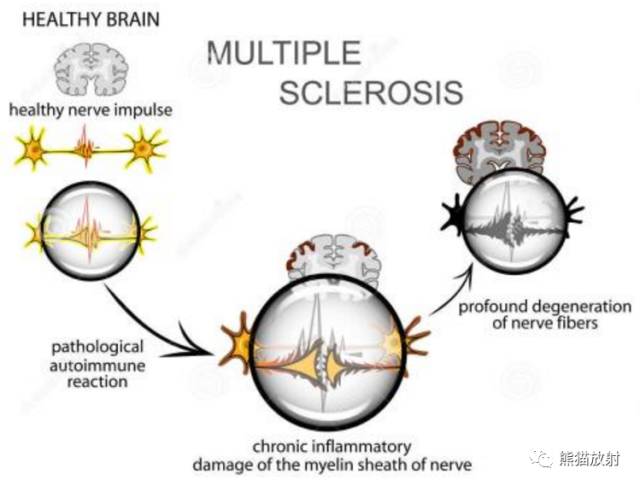 多发性硬化(MS)、急性播散性脑脊髓炎(ADEM) 多发性硬化(MS)、急性播散性脑脊髓炎(ADEM)