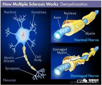 多发性硬化(MS)、急性播散性脑脊髓炎(ADEM) 多发性硬化(MS)、急性播散性脑脊髓炎(ADEM)