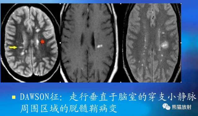 多发性硬化(MS)、急性播散性脑脊髓炎(ADEM) 多发性硬化(MS)、急性播散性脑脊髓炎(ADEM)