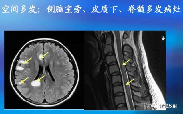 多发性硬化(MS)、急性播散性脑脊髓炎(ADEM) 多发性硬化(MS)、急性播散性脑脊髓炎(ADEM)