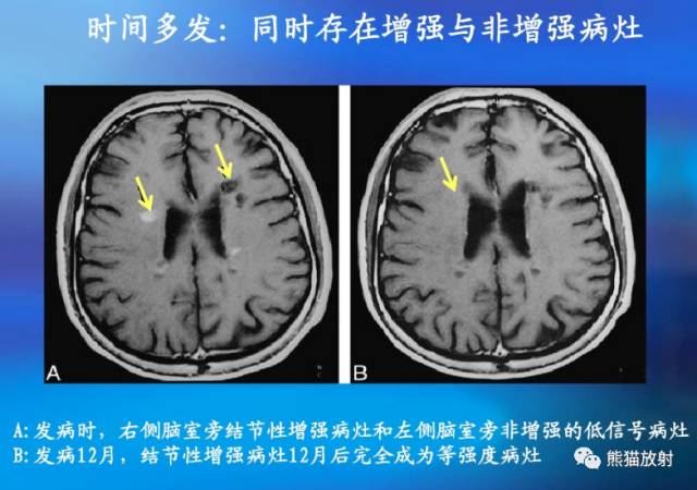 多发性硬化(MS)、急性播散性脑脊髓炎(ADEM) 多发性硬化(MS)、急性播散性脑脊髓炎(ADEM)