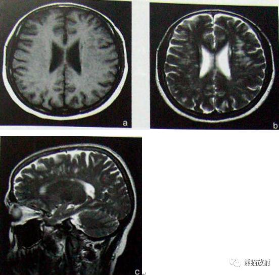 多发性硬化(MS)、急性播散性脑脊髓炎(ADEM) 多发性硬化(MS)、急性播散性脑脊髓炎(ADEM)