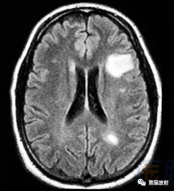 多发性硬化(MS)、急性播散性脑脊髓炎(ADEM) 多发性硬化(MS)、急性播散性脑脊髓炎(ADEM)