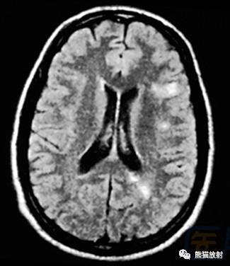 多发性硬化(MS)、急性播散性脑脊髓炎(ADEM) 多发性硬化(MS)、急性播散性脑脊髓炎(ADEM)