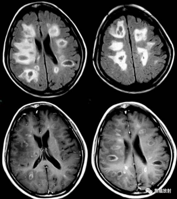 多发性硬化(MS)、急性播散性脑脊髓炎(ADEM) 多发性硬化(MS)、急性播散性脑脊髓炎(ADEM)
