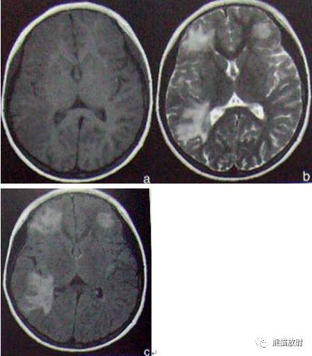 多发性硬化(MS)、急性播散性脑脊髓炎(ADEM) 多发性硬化(MS)、急性播散性脑脊髓炎(ADEM)