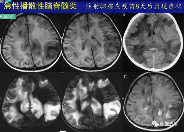 多发性硬化(MS)、急性播散性脑脊髓炎(ADEM) 多发性硬化(MS)、急性播散性脑脊髓炎(ADEM)