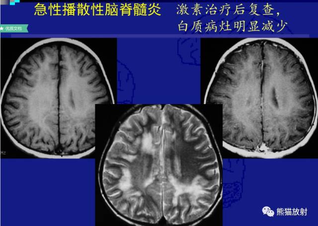 多发性硬化(MS)、急性播散性脑脊髓炎(ADEM) 多发性硬化(MS)、急性播散性脑脊髓炎(ADEM)