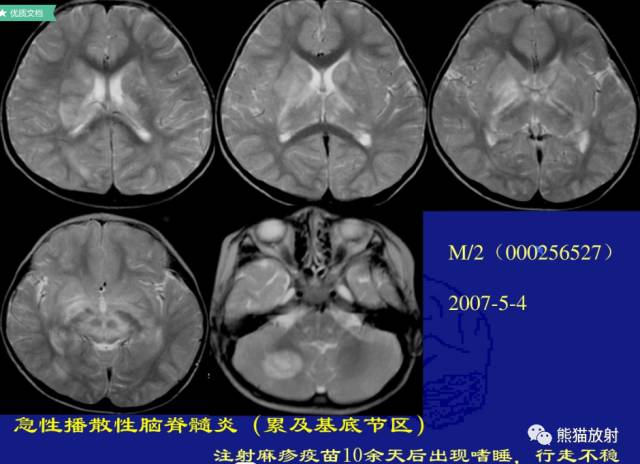 多发性硬化(MS)、急性播散性脑脊髓炎(ADEM) 多发性硬化(MS)、急性播散性脑脊髓炎(ADEM)