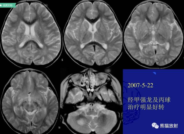 多发性硬化(MS)、急性播散性脑脊髓炎(ADEM) 多发性硬化(MS)、急性播散性脑脊髓炎(ADEM)