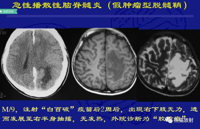 多发性硬化(MS)、急性播散性脑脊髓炎(ADEM) 多发性硬化(MS)、急性播散性脑脊髓炎(ADEM)