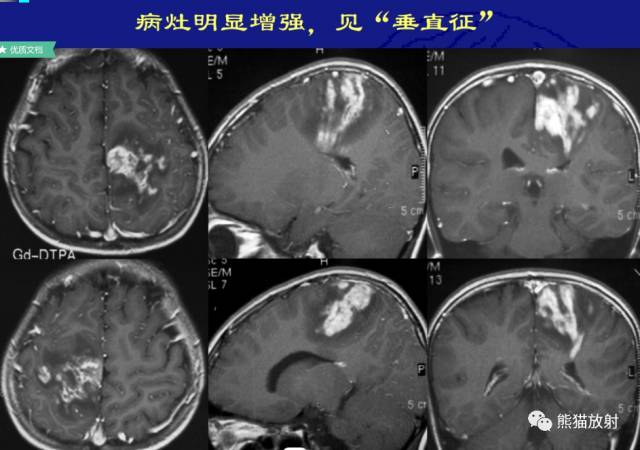 多发性硬化(MS)、急性播散性脑脊髓炎(ADEM) 多发性硬化(MS)、急性播散性脑脊髓炎(ADEM)