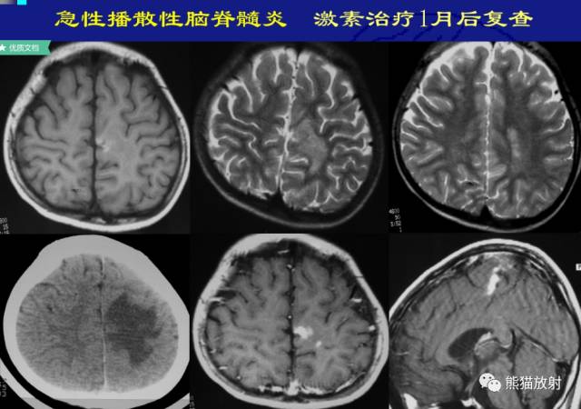 多发性硬化(MS)、急性播散性脑脊髓炎(ADEM) 多发性硬化(MS)、急性播散性脑脊髓炎(ADEM)