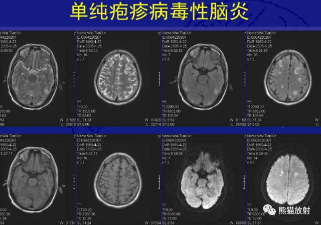 多发性硬化(MS)、急性播散性脑脊髓炎(ADEM) 多发性硬化(MS)、急性播散性脑脊髓炎(ADEM)