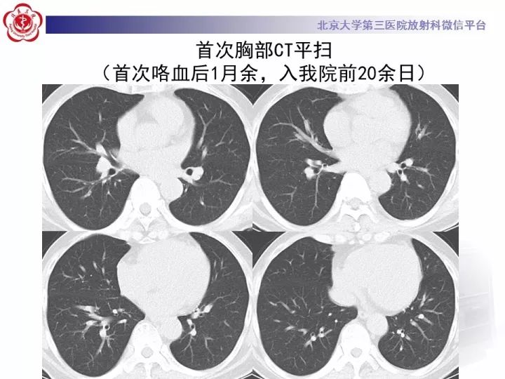 【病例】支气管动脉相关的咯血1例CT影像表现