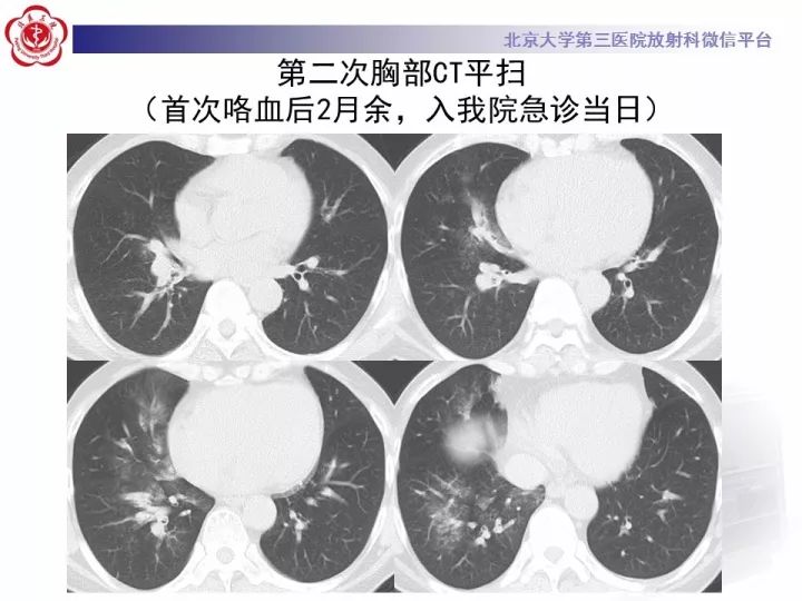 【病例】支气管动脉相关的咯血1例CT影像表现