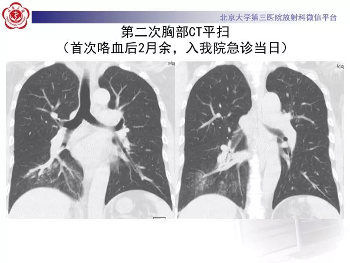 【病例】支气管动脉相关的咯血1例CT影像表现