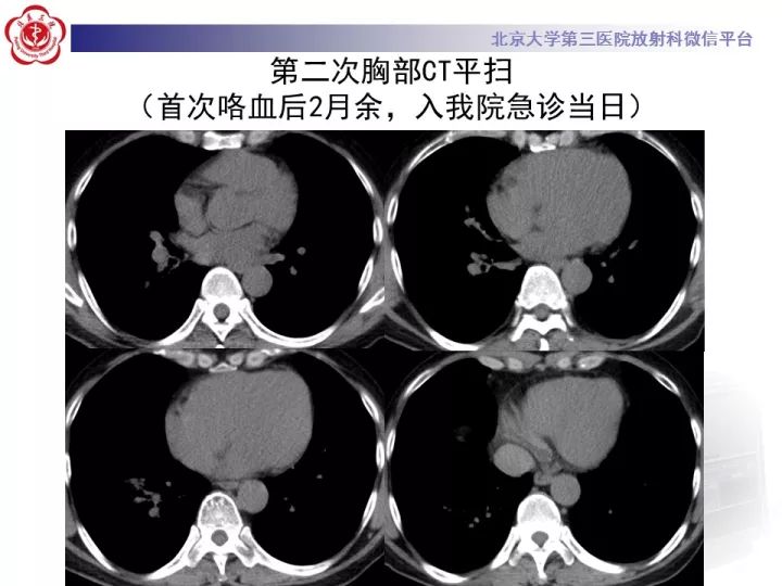 【病例】支气管动脉相关的咯血1例CT影像表现