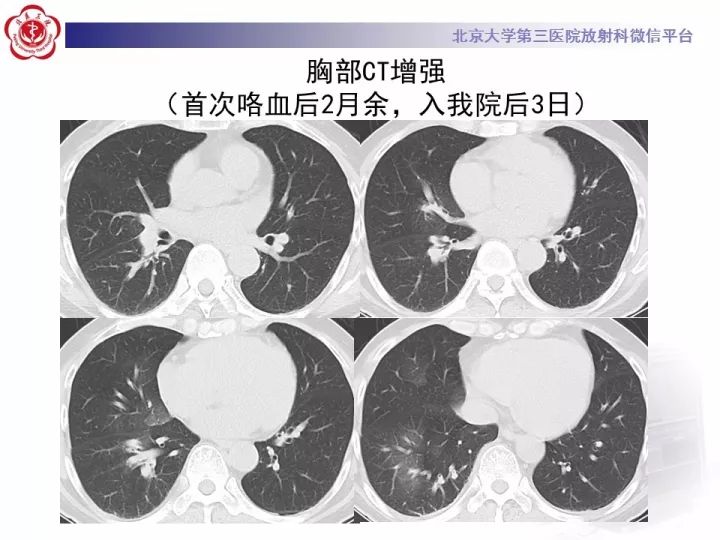 【病例】支气管动脉相关的咯血1例CT影像表现