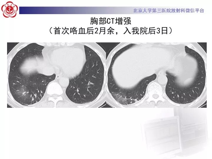 【病例】支气管动脉相关的咯血1例CT影像表现