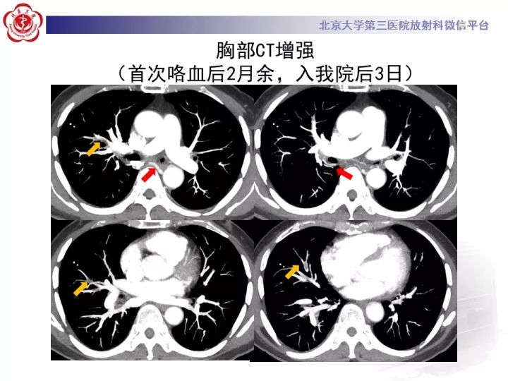 【病例】支气管动脉相关的咯血1例CT影像表现