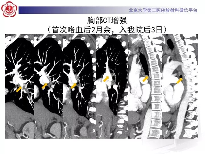 【病例】支气管动脉相关的咯血1例CT影像表现