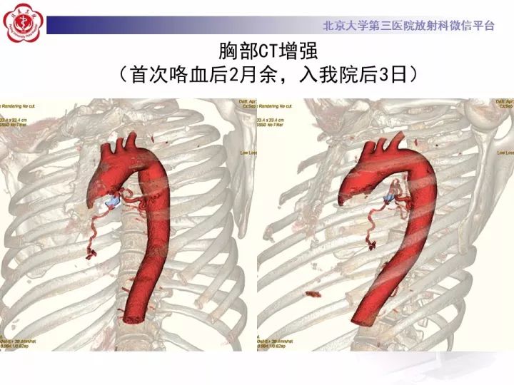 【病例】支气管动脉相关的咯血1例CT影像表现